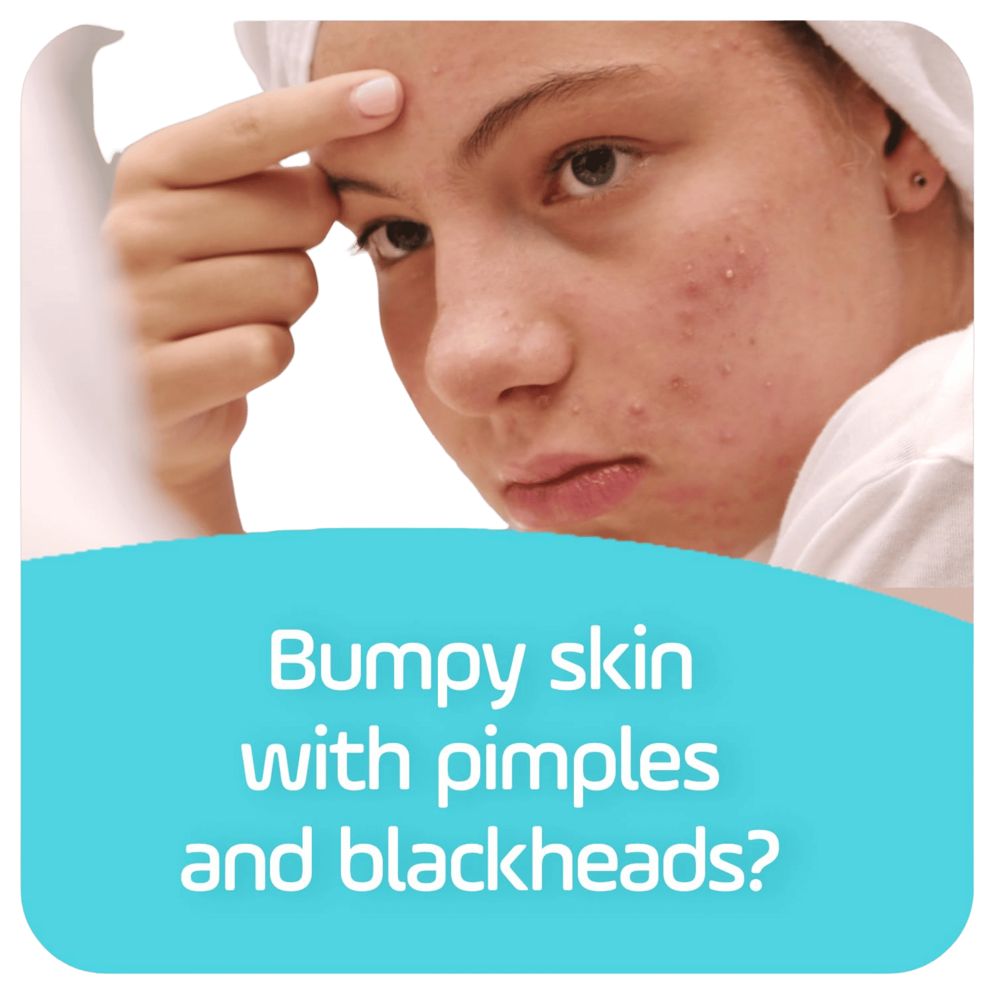 Asepxia Scrub Acne Bar Soap (113 g) SkinStash