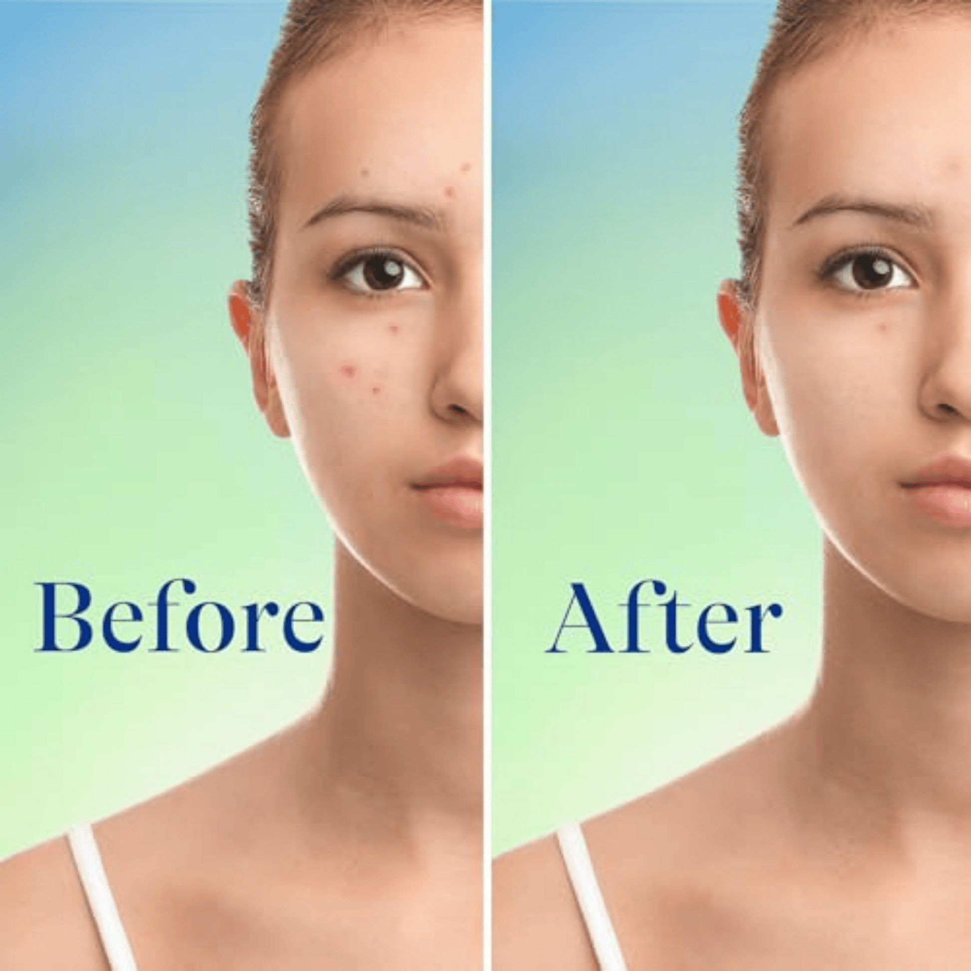 Differin 10% Benzoyl Peroxide Acne Foaming Cleanser (148ml) SkinStash