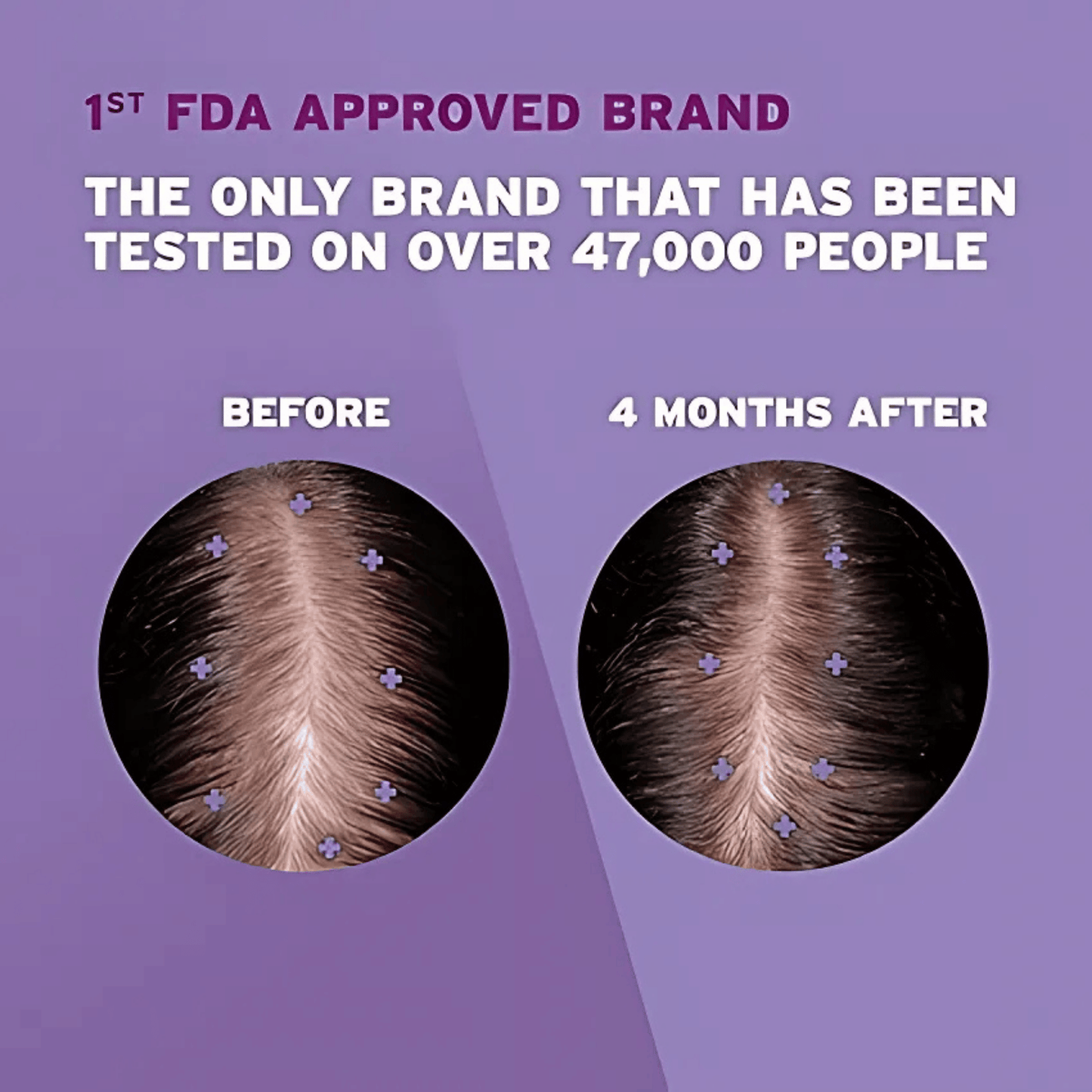 Rogaine Women's 2% Minoxidil Topical Solution Hair Regrowth Treatment (3x60ml) SkinStash